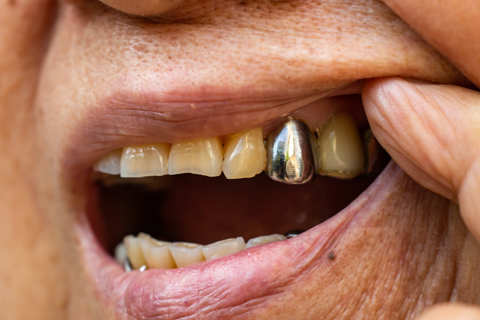 Ältere Frau mit Zahnprothese aus Silber